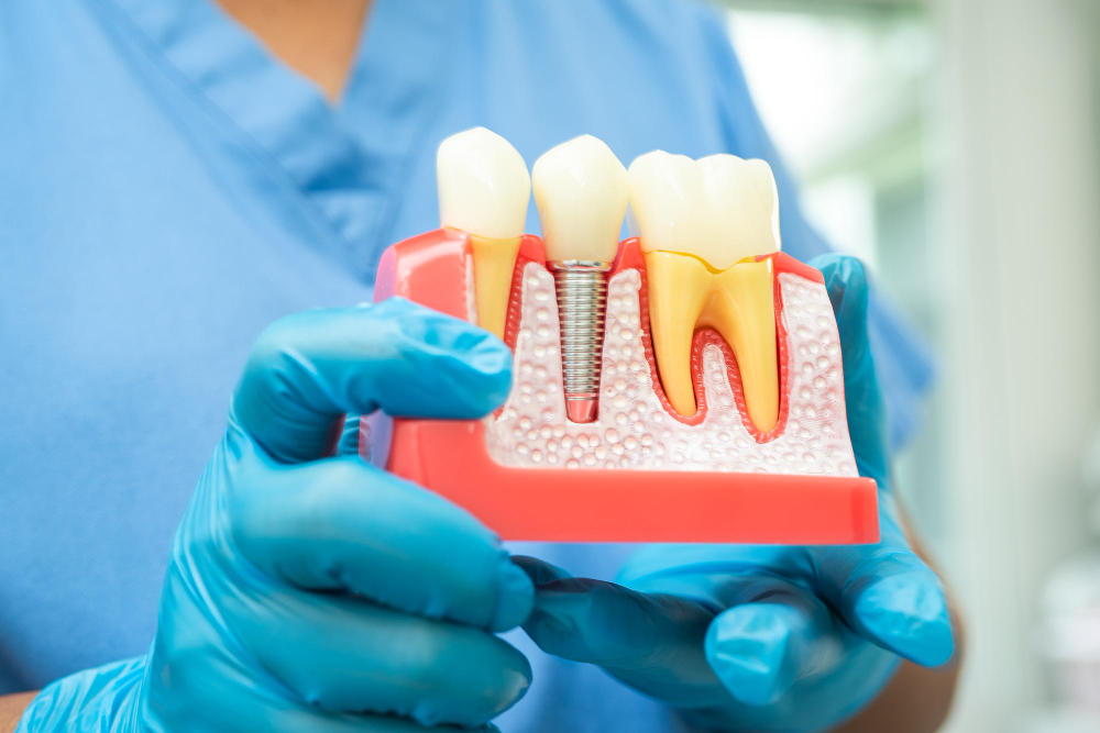 Best Dental Implants San Jose