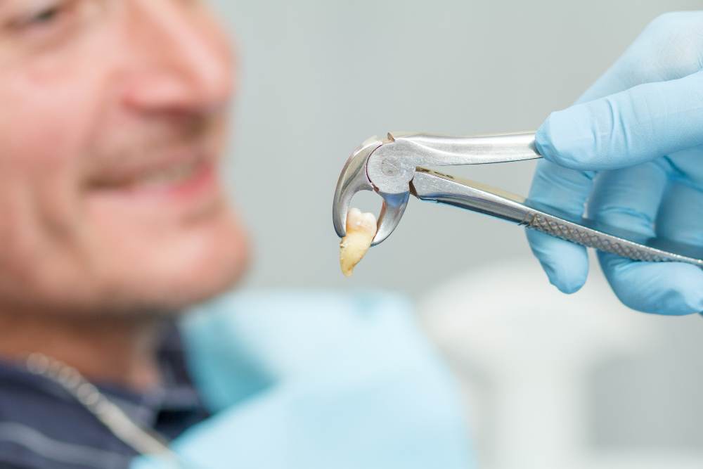 Best Tooth Extraction in San Jose