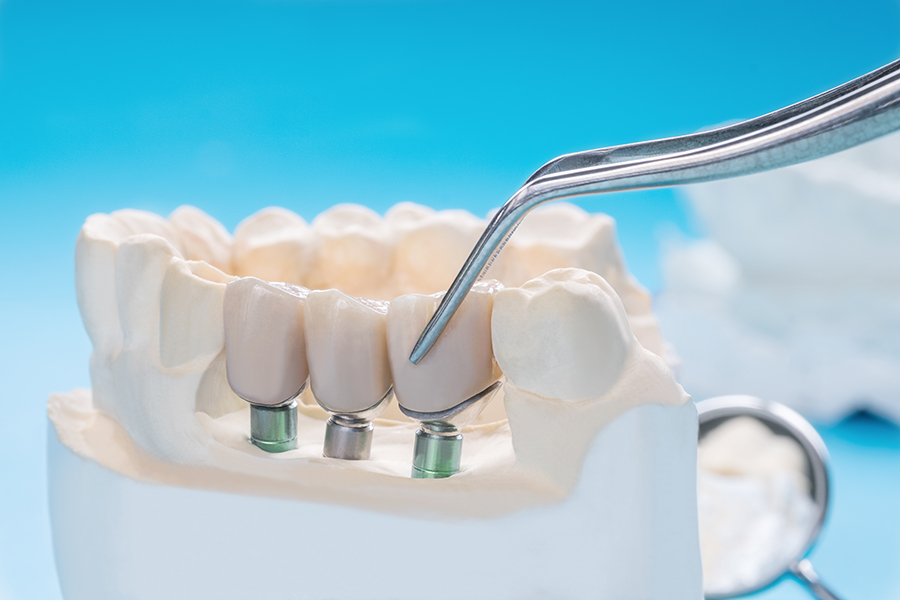 Single Tooth Implants vs. Full Arch - A Comparison