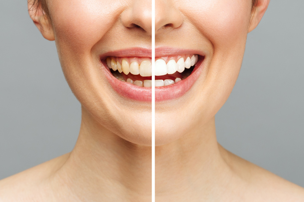 Is Teeth Whitening Safe?