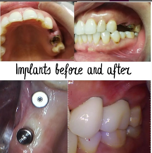 What Are Dental Implants