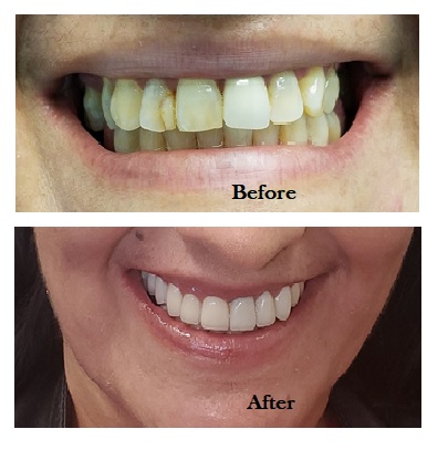 Teeth Whitening Treatment In San Jose
