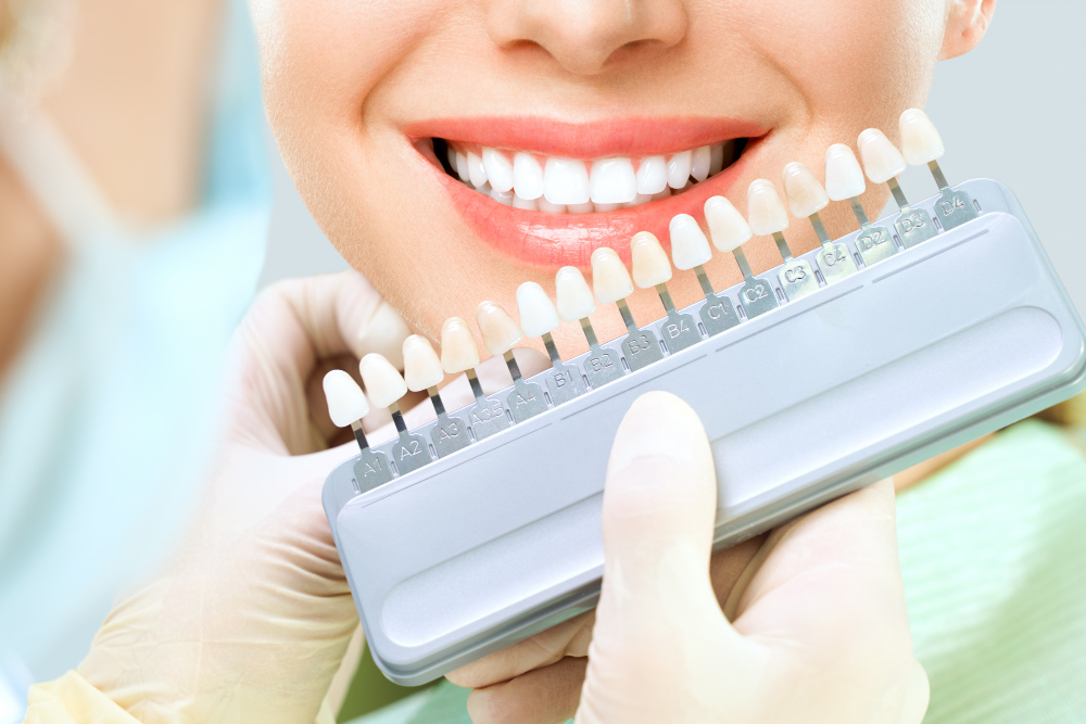 Trusted Dental Veneers in San Jose